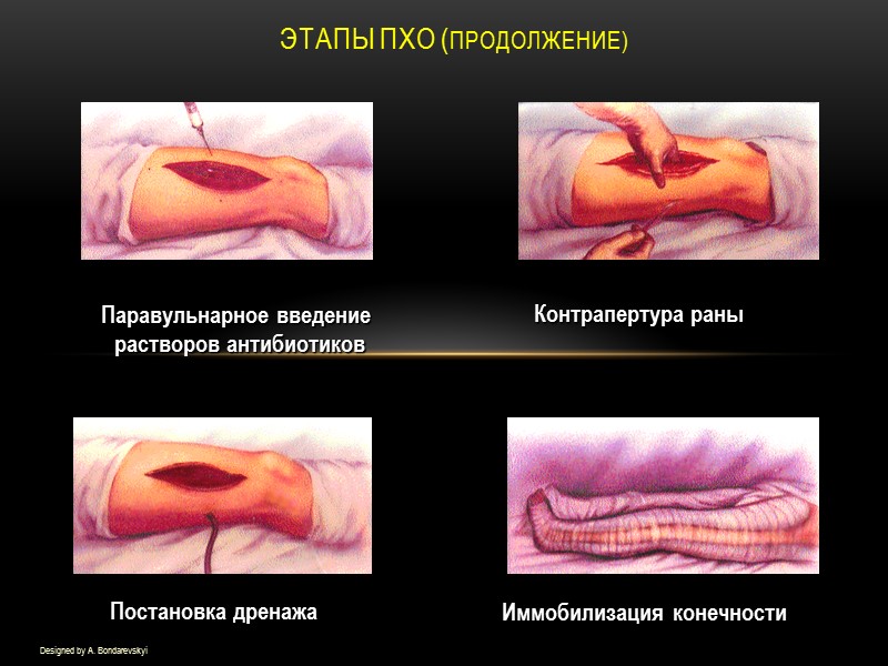 Этапы ПХО (продолжение) Designed by A. Bondarevskyi Паравульнарное введение  растворов антибиотиков Контрапертура раны
